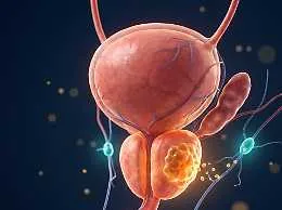 Carcinoma prostatico: studi sulle combinazioni terapeutiche